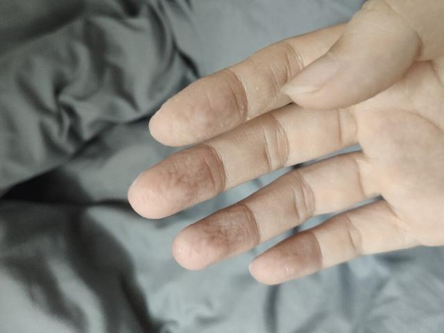 手指头像泡水一样褶皱